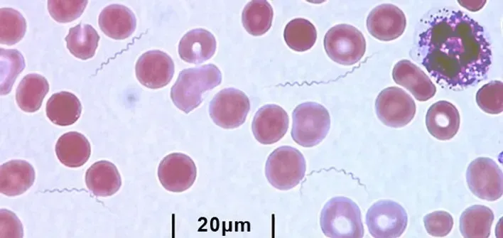 Lyme Coinfection Series – Tick-borne Relapsing Fever
