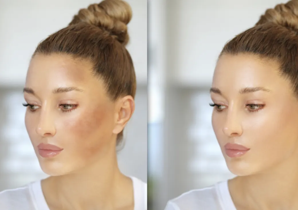 Melasma