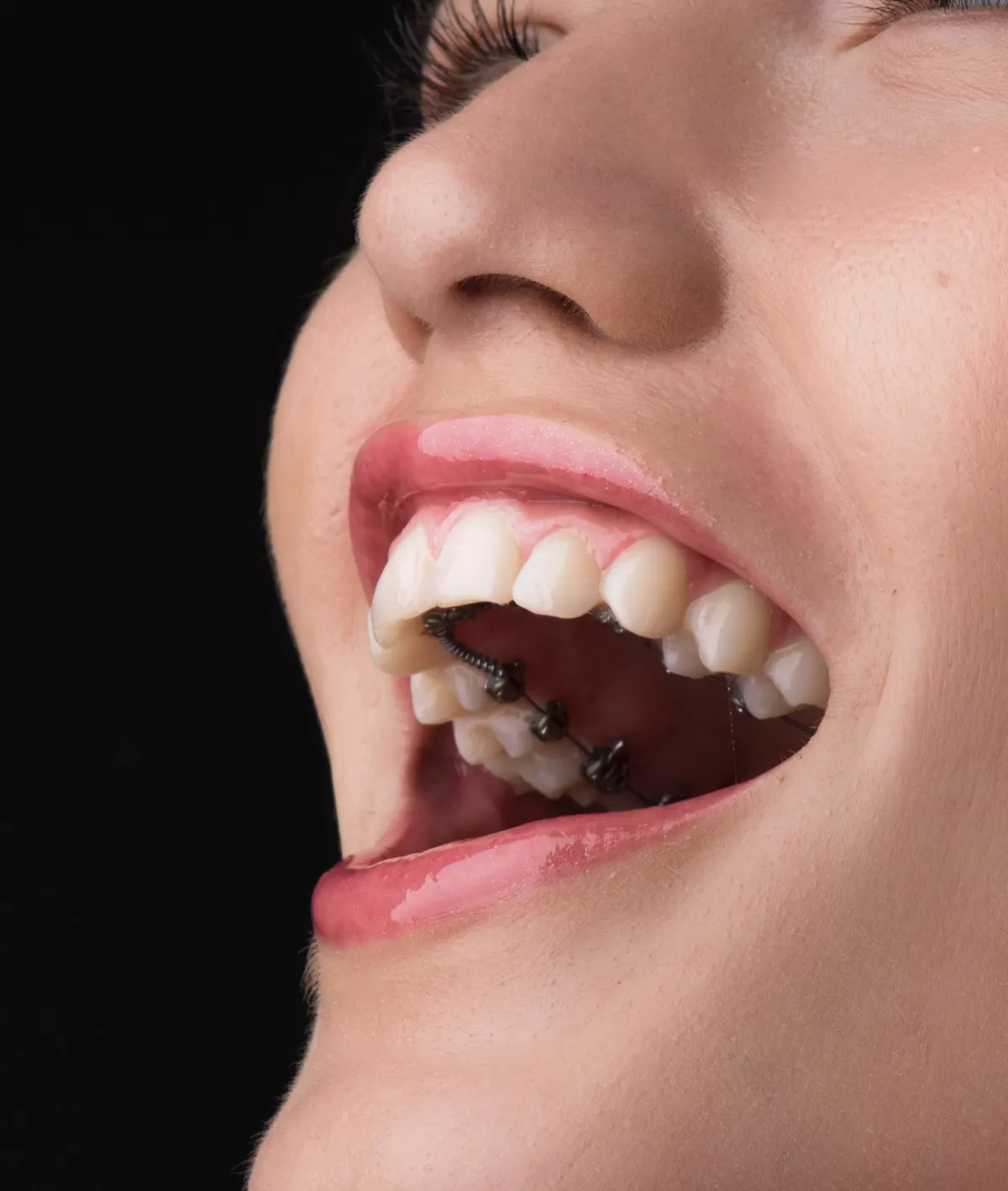 Ortodoncia Lingual en Chile