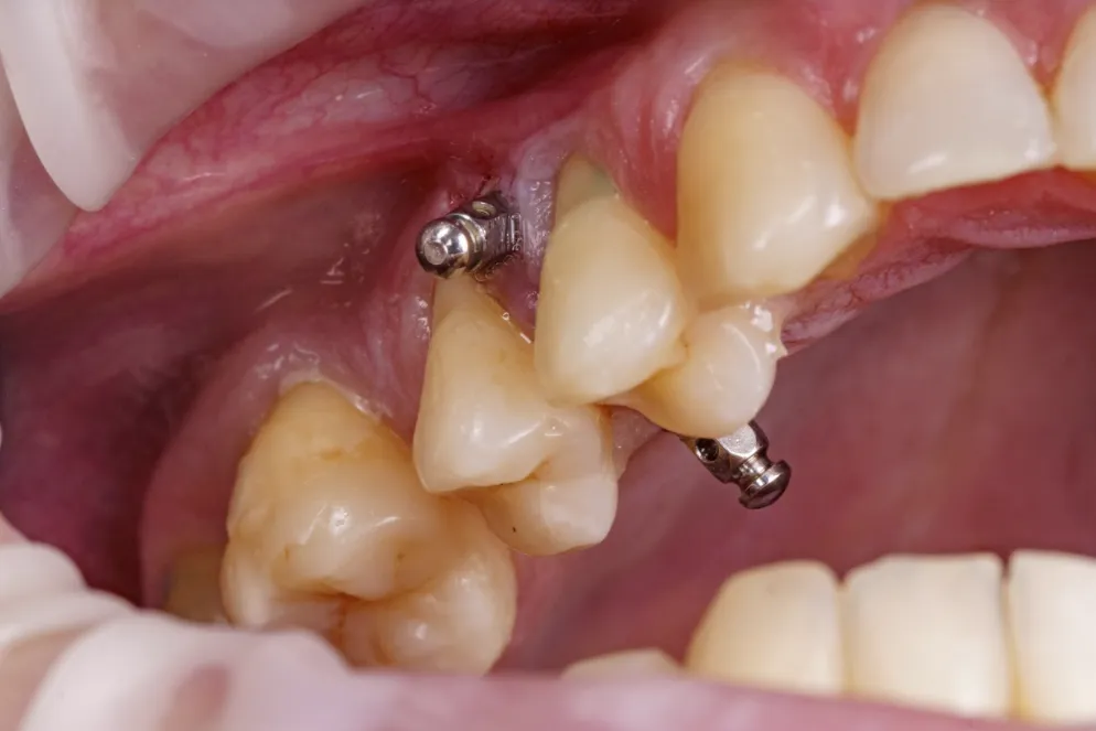 Microimplantes