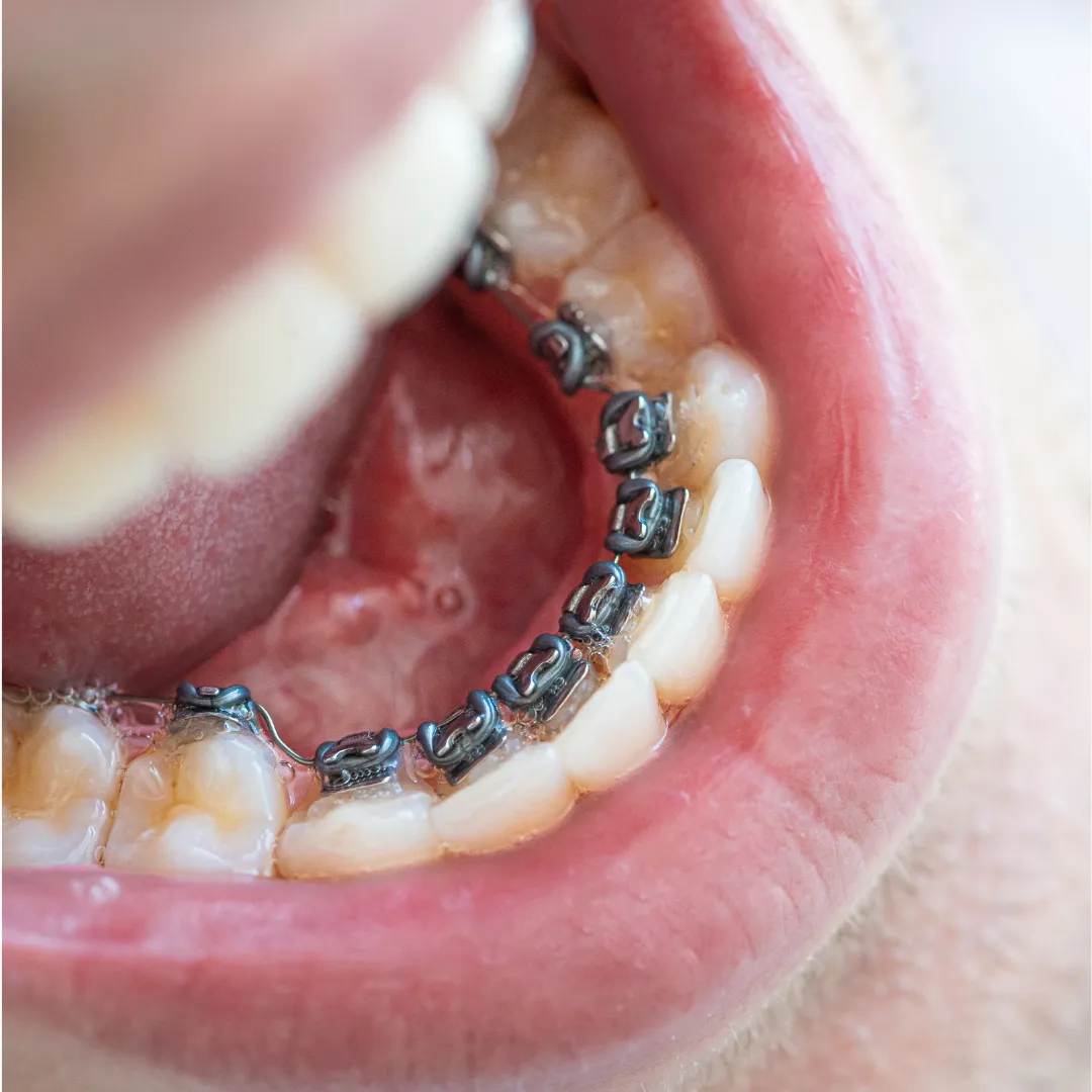 Odontologia invisible lingual