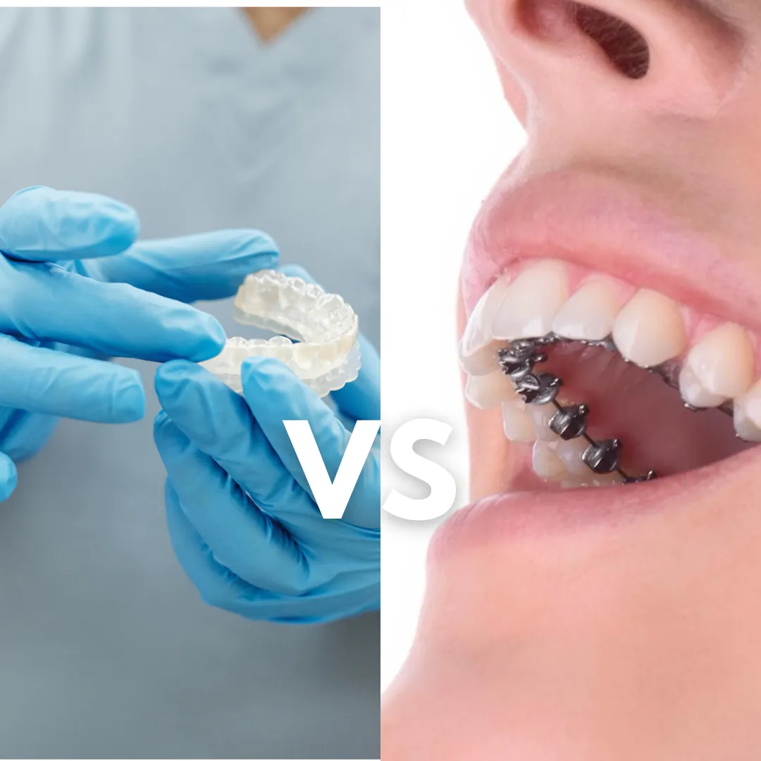 Invisalign vs ortodoncia