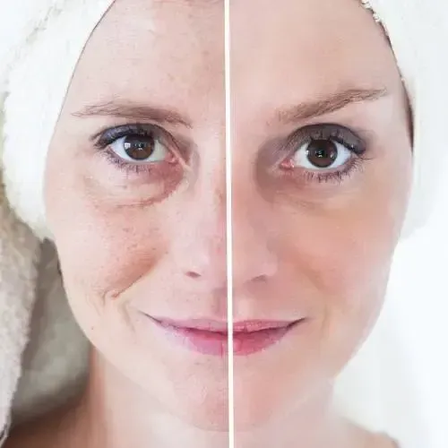 Before and After Laser Skin Resurfacing at CResultsBeauty
