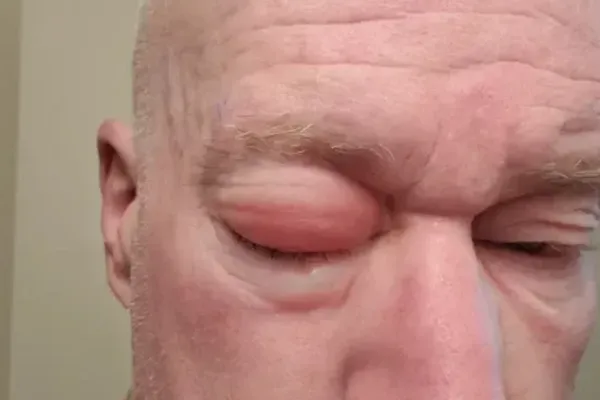Tim Clark, 55, Spontaneous Tear Of The Retina