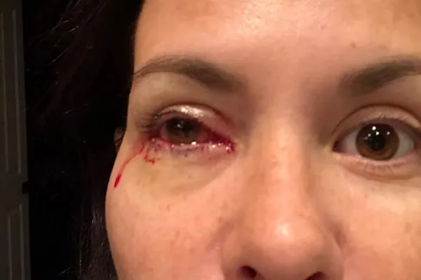 Anna, 48 - eye injury