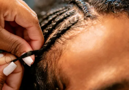 Traction Alopecia