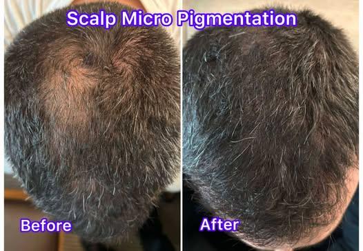 Scalp Micropigmentation (SMP)