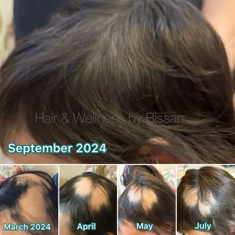 Case: Alopecia Areata