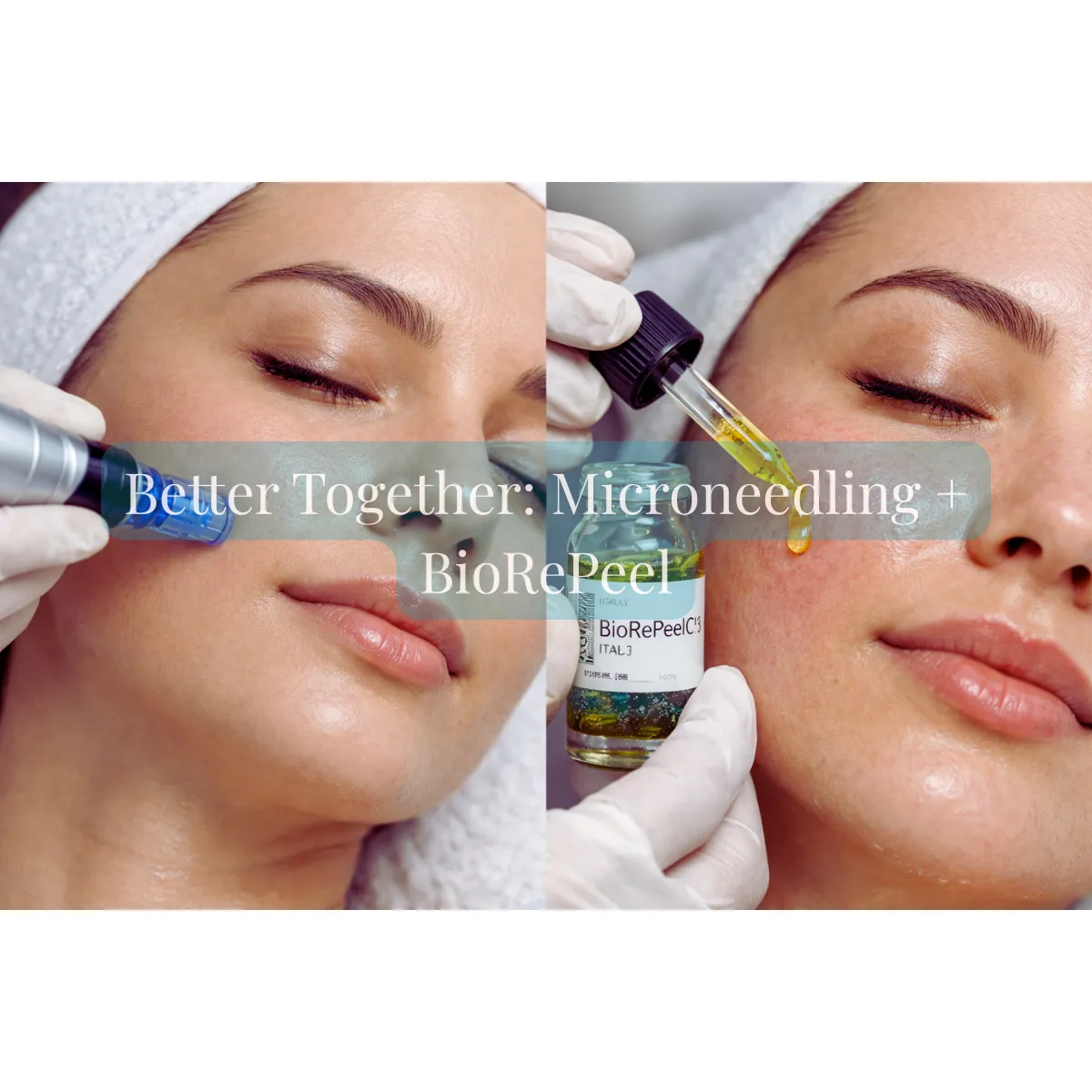 Microneedling + BioRePeel in Prescott, AZ