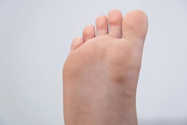 What Causes Verrucas—And How to Stop Them Spreading