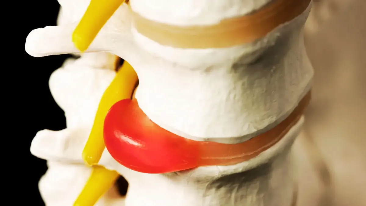 Herniated Disc