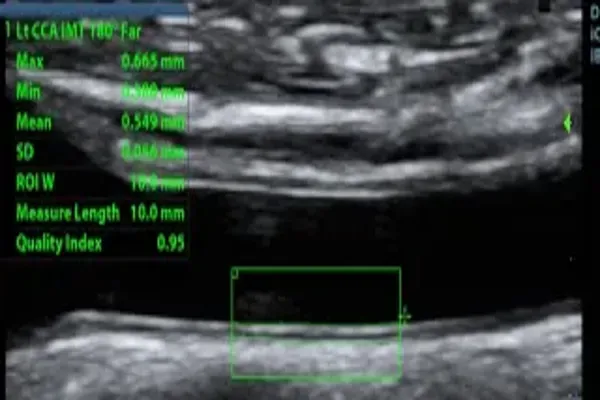 Clinical significance of carotid intima-media thickness