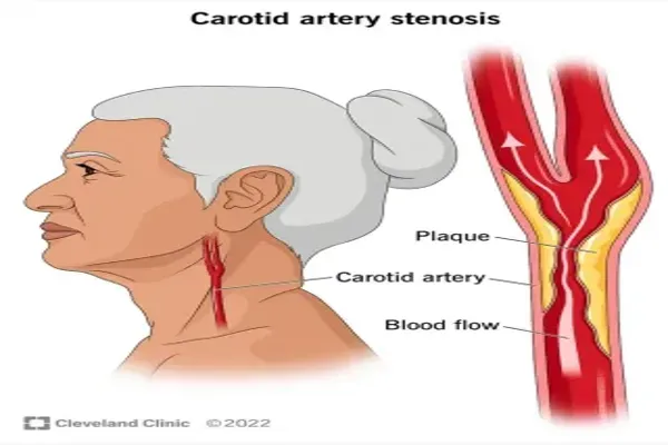 Carotid plaque and heart health