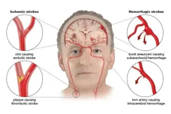 Recognizing a stroke