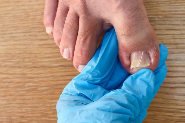 doctor examining an ingrown toenail on large thumb