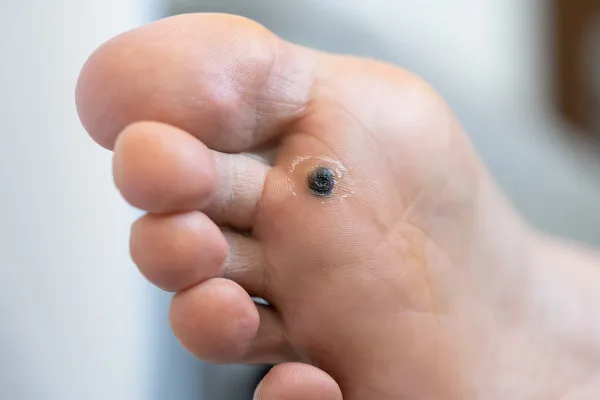 foot with plantar warts