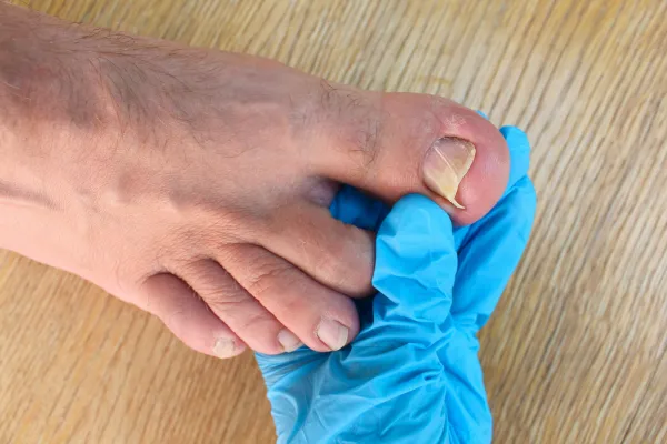 doctor examining an ingrown toenail