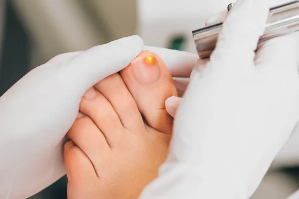 laser treatment for fungal nails