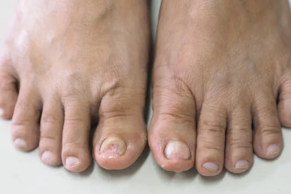 Fungal Toenail Infections Explained: Understanding Onychomycosis