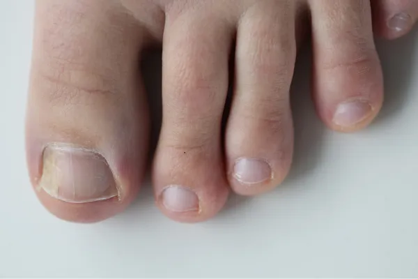 Sesamoiditis: A Tiny Bone Causing Big Foot Pain