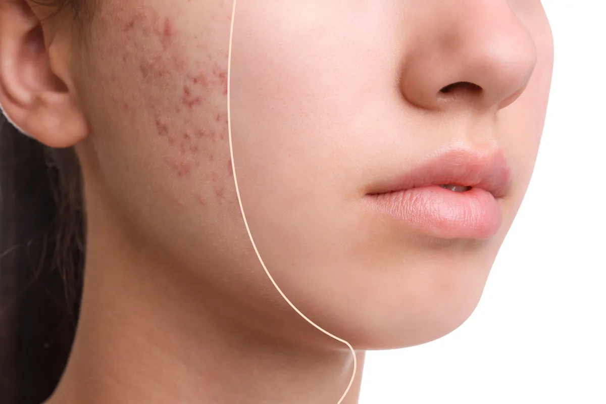 Acne 