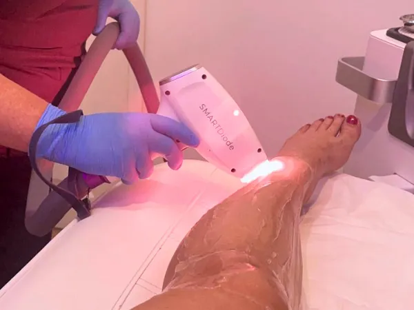 The Latest in Laser Hair Removal Technology
