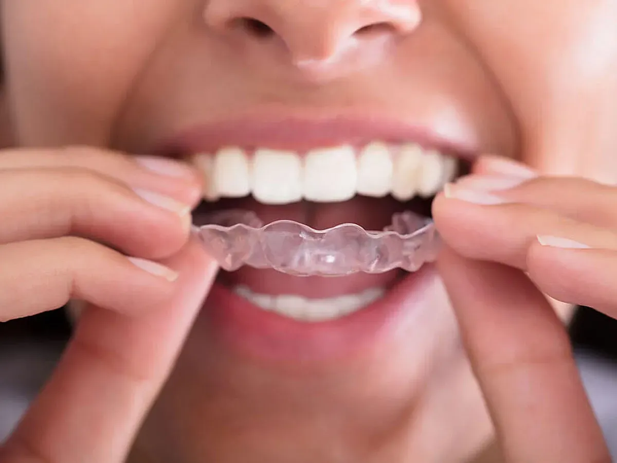 Invisible Orthodontics