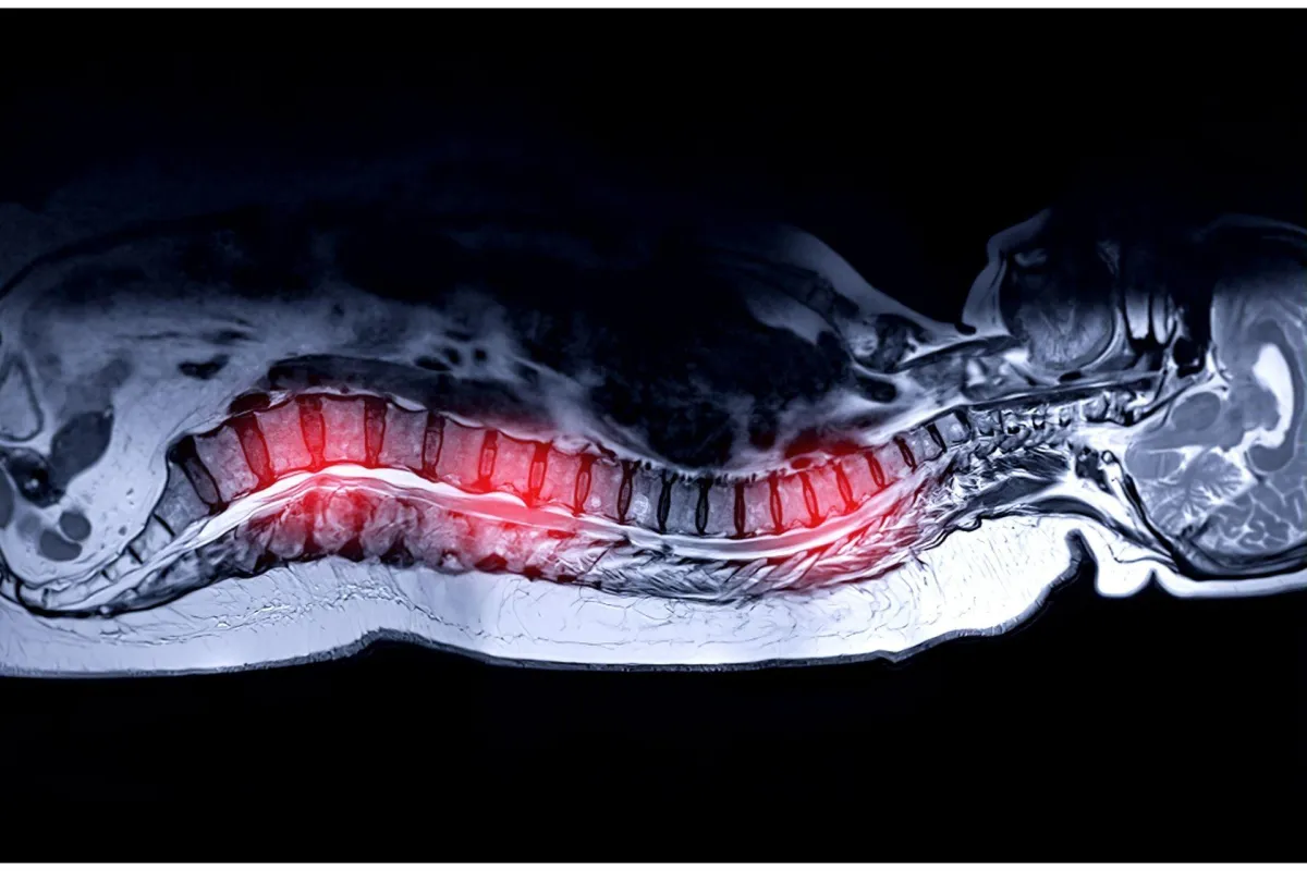 disc herniation