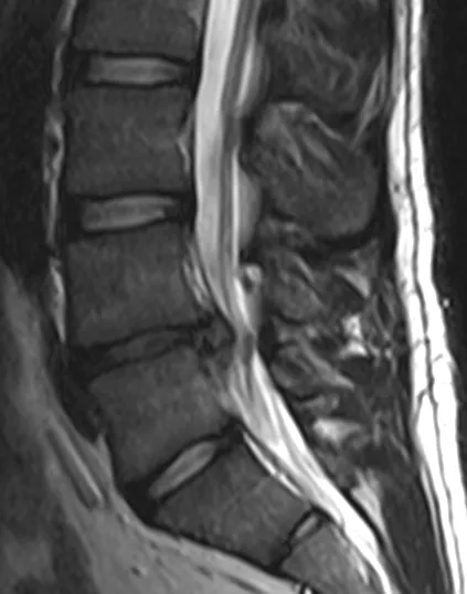 Non Surgical Treatment for Disc Herniations
