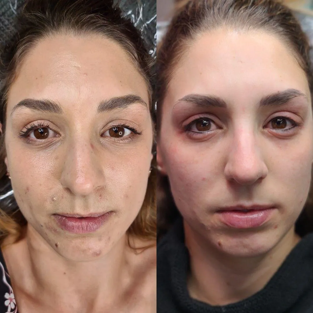 image is skin before and after of acne being treated with O cosmedics homecare and peels + dermapen 4 for rejuvenation and acne scar work