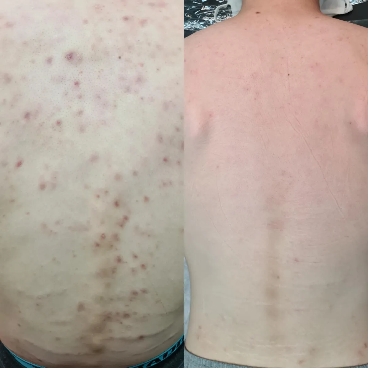 dermapen - microneedling transformation at feather touch aesthetics moonah - before and after of acne on our clients back. showing the difference of 1 session of dermapen for acne