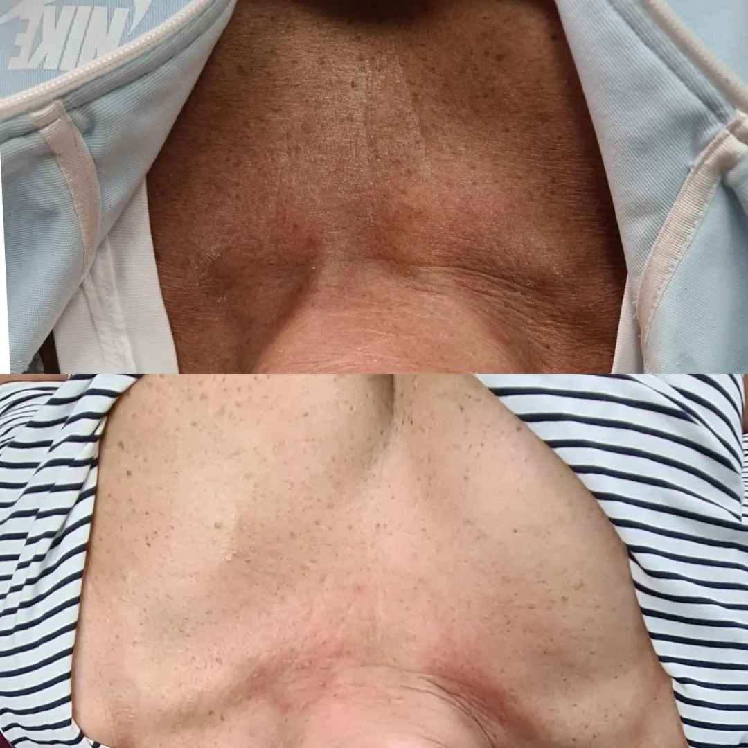 pigmentation before and after - showing the clinical results of dermpen treatments for evening skin tone at feather touch aesthetics hobart