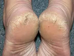 Don't ignore the cracks: When cracked heels get serious