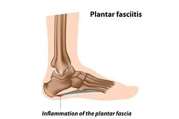 Understanding Plantar Fasciitis