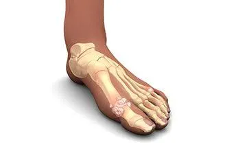 Triggers for a gout attack