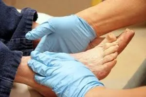 Explore the complexities of diabetic foot complications in our blog, delving into risks, symptoms, and management strategies for serious conditions like neuropathy, ulcers, and infections. Stay informed to safeguard your foot health