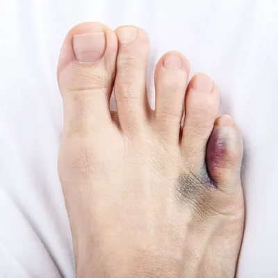 Symptoms of a Broken Toe