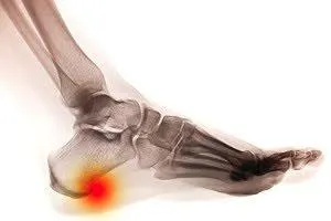 Understanding heel spurs