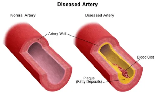 All About Peripheral Artery Disease