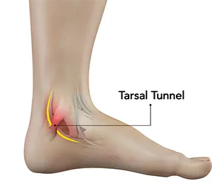 foot stretching that alleviate Tarsal Tunnel Syndrome symptoms