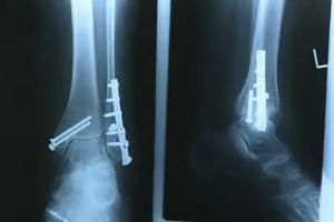 Do I Have a Stress Fracture?