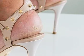 Understanding cracks in heels