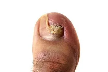  Stubborn Toenail Fungus? Meds Might Be Your Ally