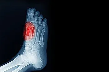 Understanding Sesamoiditis