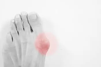 Understanding Bunions