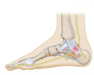 Tarsal Tunnel Syndrome 101
