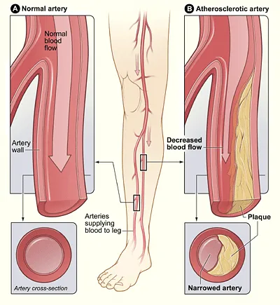 Understanding PAD