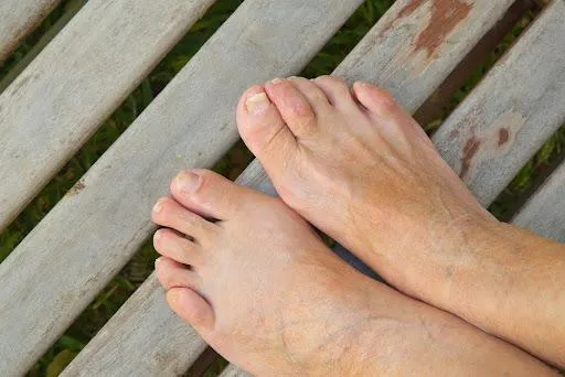 Understanding Hammertoes 