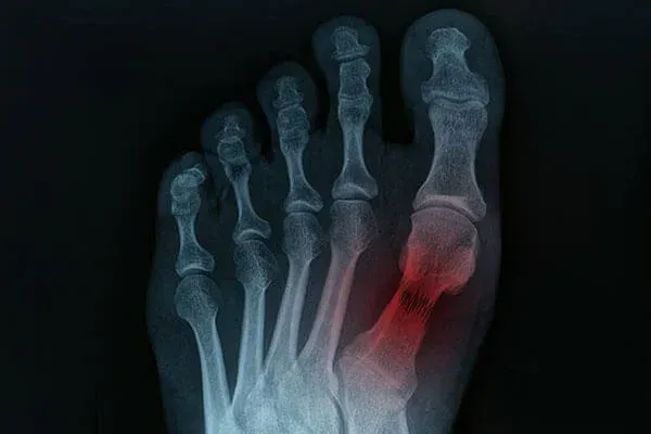 Understanding toe fractures