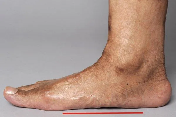 Understanding Flat Feet
